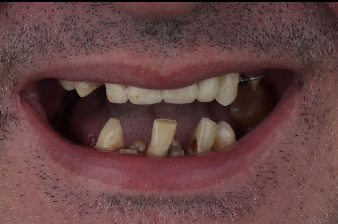 Antes e depois — caso 4